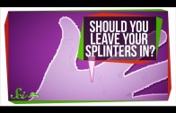 What Happens If You Don’t Take out a Splinter?