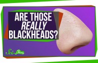 Are Those Really Blackheads?